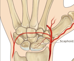 Scaphoid Fractures - Canberra Hand Centre